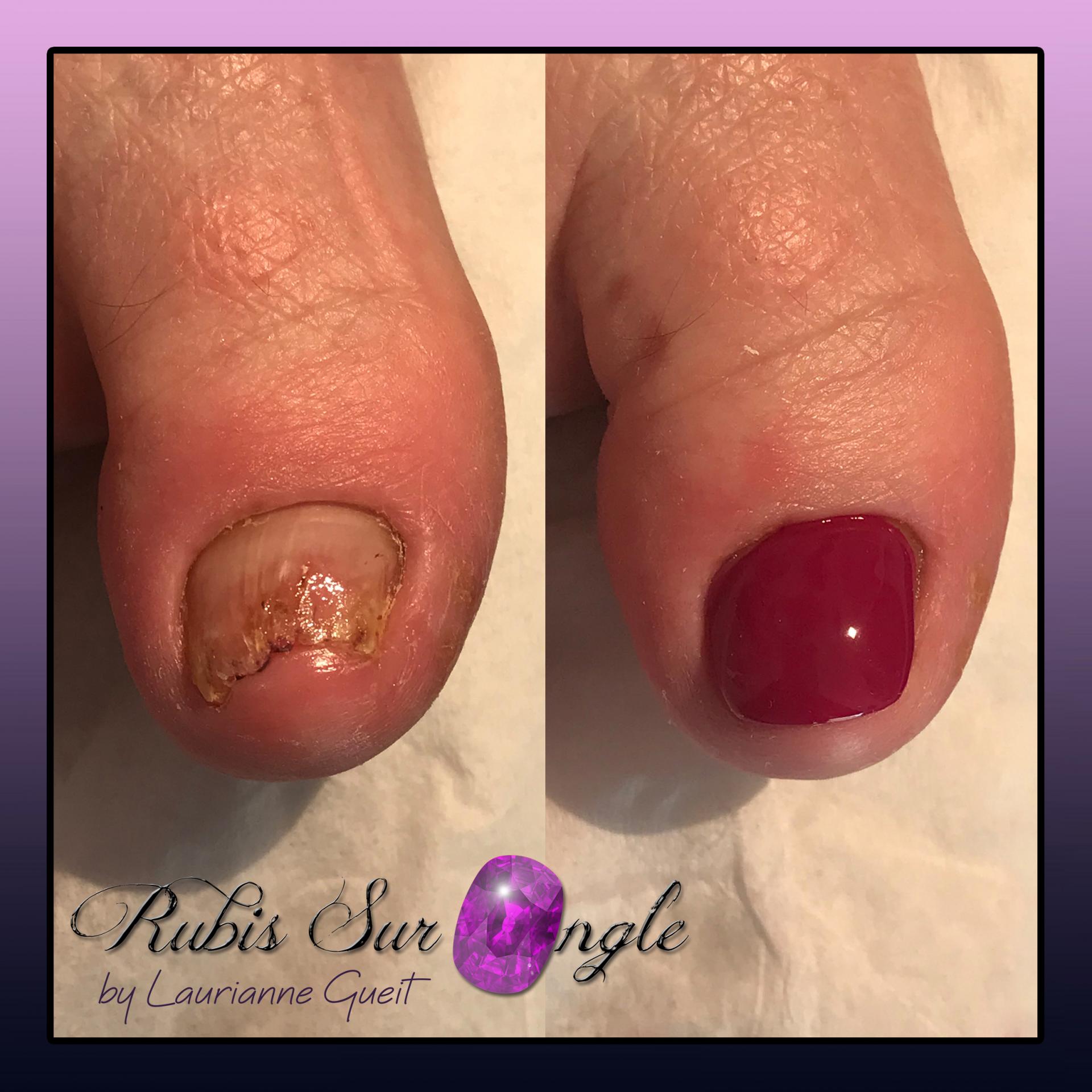 Rubis Sur Ongle Reconstruction